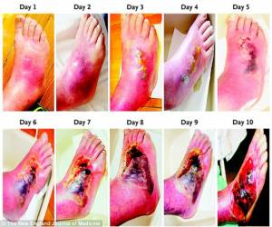 diabetic foot ulcer progression