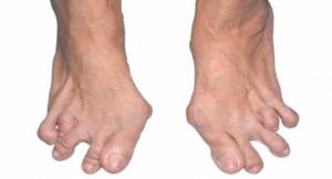 rheumatoid arthritis foot splaying toes