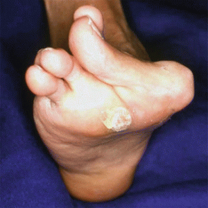 rheumatoid foot with bunion and callus